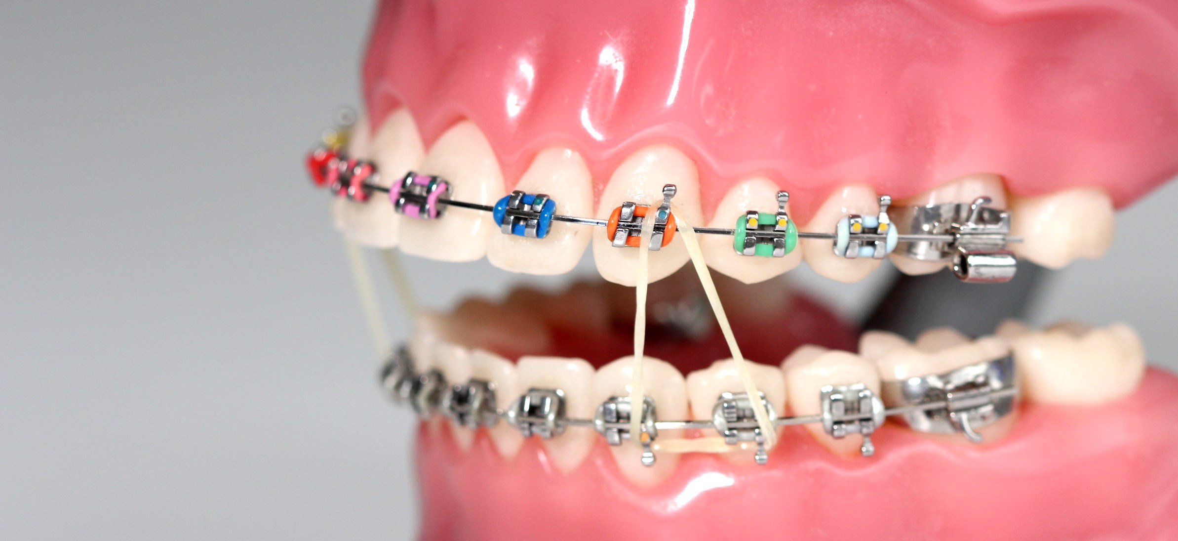 Unionville Orthodontics What Do Rubber Bands Do For Braces Orthodontist Markham Braces Markham Orthodontist Markham