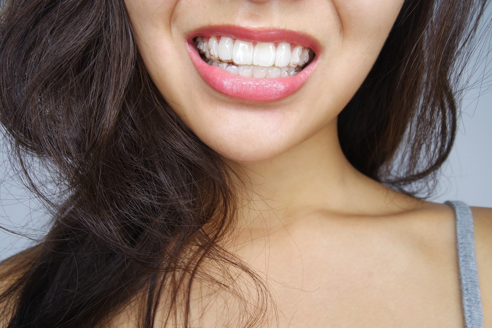 What are Invisalign Attachments? Orthodontist Markham Braces