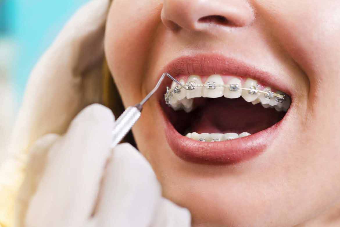 Orthodontic Emergencies – What to Do?