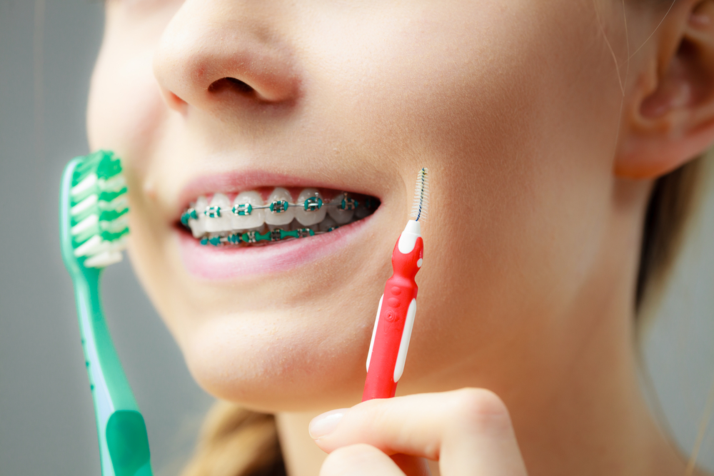 Teeth Discolouration with Braces